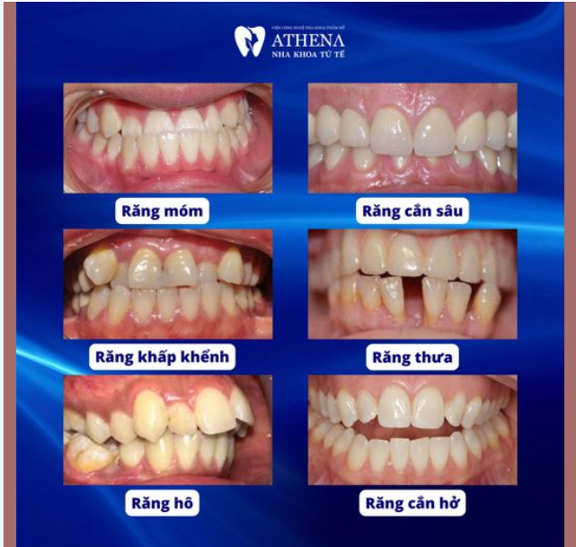Niềng răng là một giải pháp hiệu quả giúp cải thiện sự sai lệch của hàm răng, từ đó nâng cao khả năng ăn nhai và sự tự tin trong giao tiếp.
