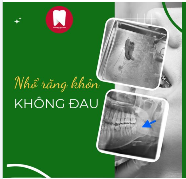 TẠM BIỆT RĂNG KHÔN BẰNG TRẢI NGHIỆM NHẸ NHÀNG KHÔNG TƯỞNG