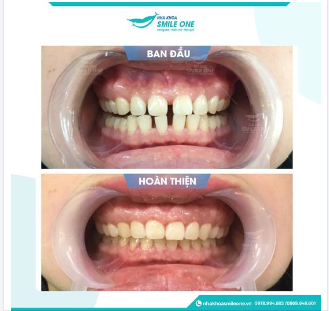 RĂNG THƯA MẤT LỘC LÀ BIỂU HIỆN CỦA VIỆC HAO TỐN TIỀN CỦA???
