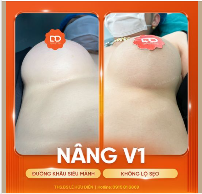 Đường khâu siêu mảnh - Không sợ sẹo - Cải thiện teo lép.