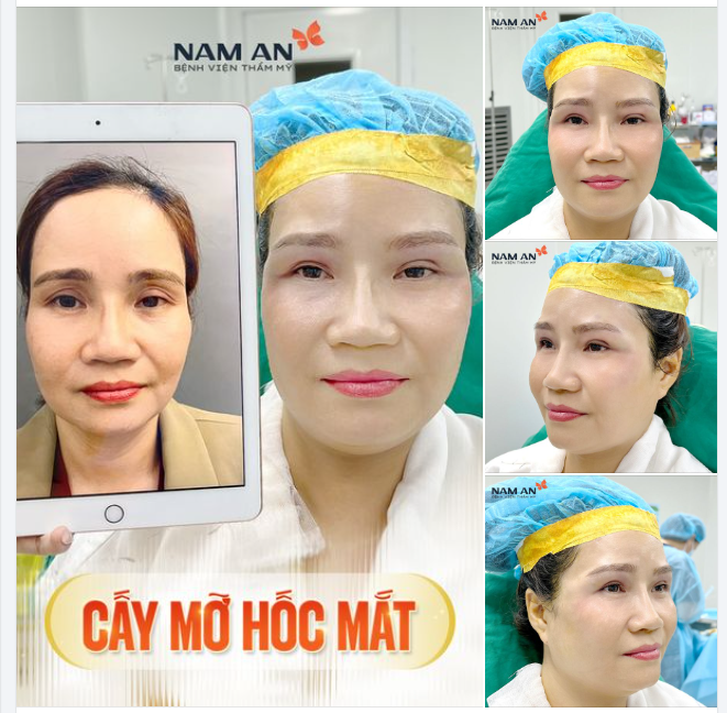 CẤY MỠ HỐC MẮT - ĐÔI MẮT RẠNG NGỜI