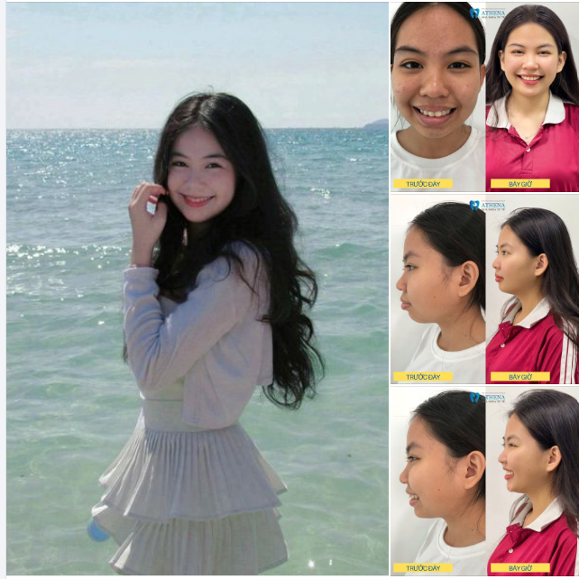 Dậy thì thành công nhờ niềng răng