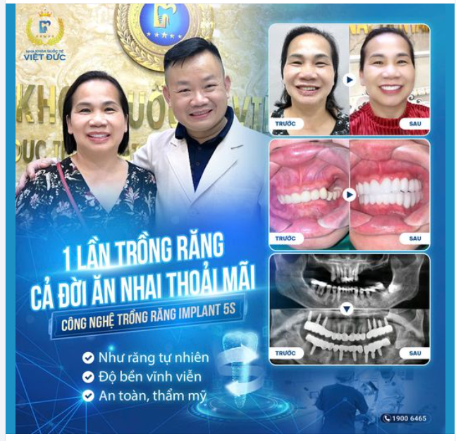 NHIỀU NĂM MẤT RĂNG, CHỊ LIÊN VUI MỪNG SAU KHI TRỒNG THÀNH CÔNG RĂNG IMPLANT