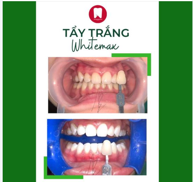BIẾN ƯỚC MƠ VỀ HÀM RĂNG TRẮNG SÁNG THÀNH HIỆN THỰC