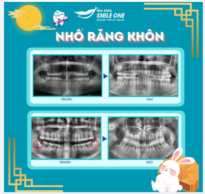 "Thứ nhất đau mắt, thứ nhì đau răng" Các cụ nói cấm có sai!