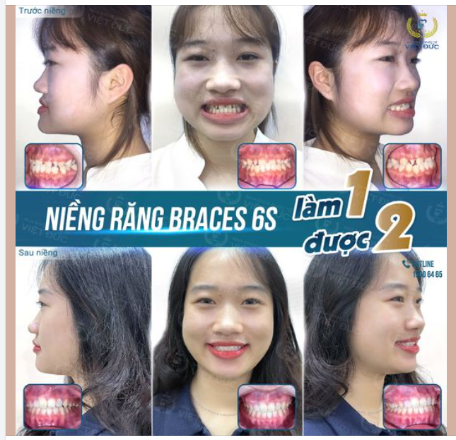 KHỚP CẮN NGƯỢC - NIỀNG RĂNG CÀNG SỚM HIỆU QUẢ CÀNG NHANH