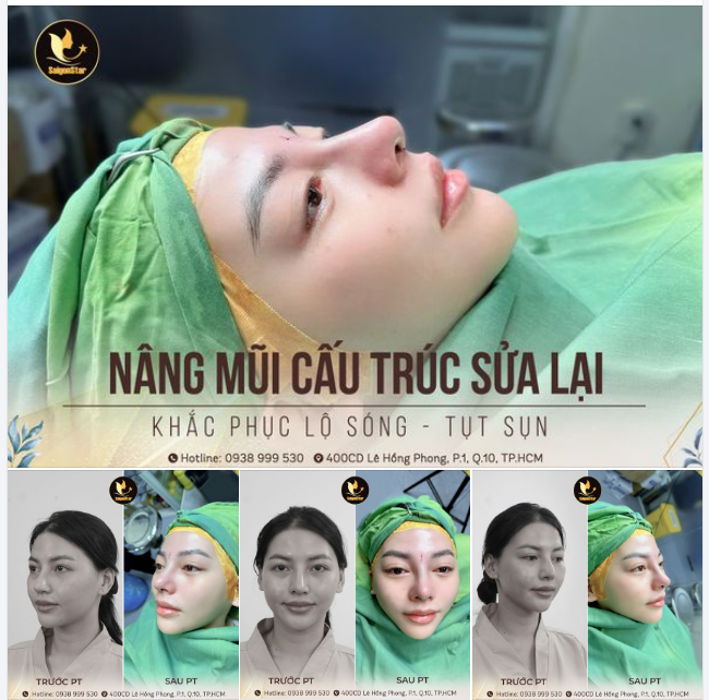 60 PHÚT KHẮC PHỤC HOÀN TOÀN KHUYẾT ĐIỂM CỦA LẦN NÂNG MŨI TRƯỚC