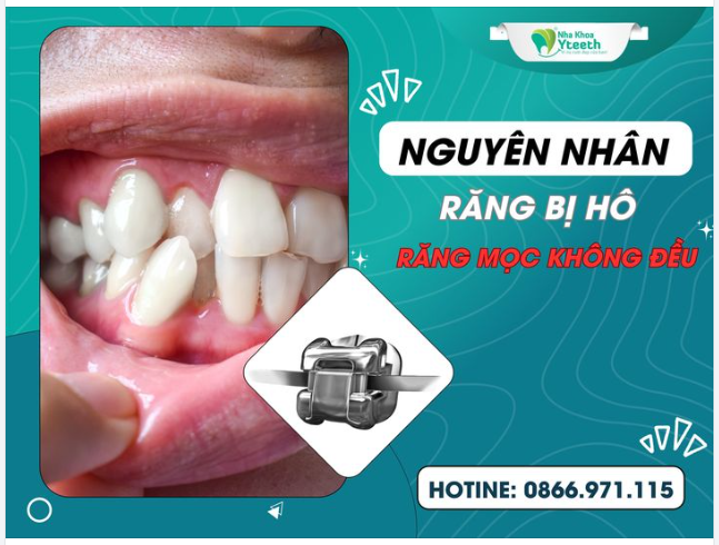 Đúng như tên gọi, nguyên nhân gây hô do răng chủ yếu xoay quanh vấn đề răng mọc không đều và thẳng hàng.