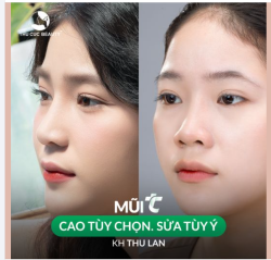 Thật tuyệt vời khi có quyết định nâng mũi tại TC