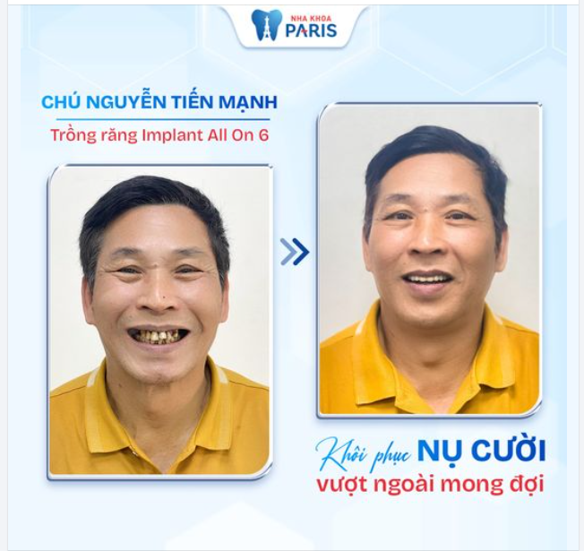 Chia sẻ của chú Mạnh sau khi thực hiện cấy ghép Implant toàn hàm tại Nha khoa Paris.