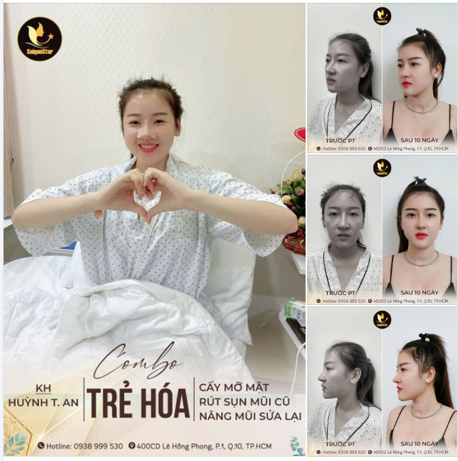 NÂNG MŨI SỬA LẠI + CẤY MỠ TOÀN MẶT TRẺ TRUNG XINH ĐẸP VƯỢT MONG ĐỢI CỦA KHÁCH HÀNG