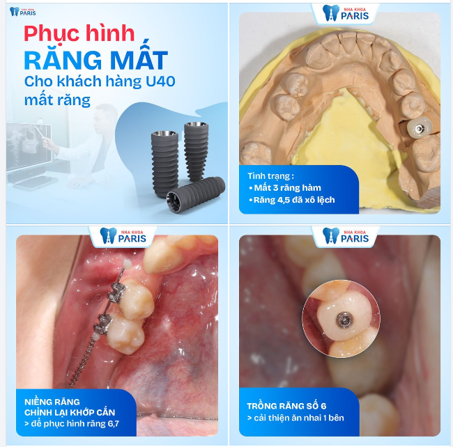 RĂNG XÔ LỆCH VÌ KHÔNG TRỒNG LẠI SỚM KHIẾN THỜI GIAN ĐIỀU TRỊ DÀI HƠN!