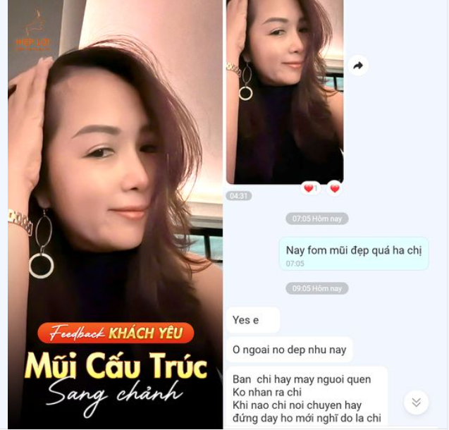 FEEDBACK sau NÂNG MŨI của khách yêu tại BVTM Hiệp Lợi