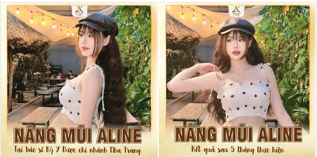 NHAN SẮC “THĂNG HẠNG” BẤT NGỜ SAU NÂNG MŨI ALINE