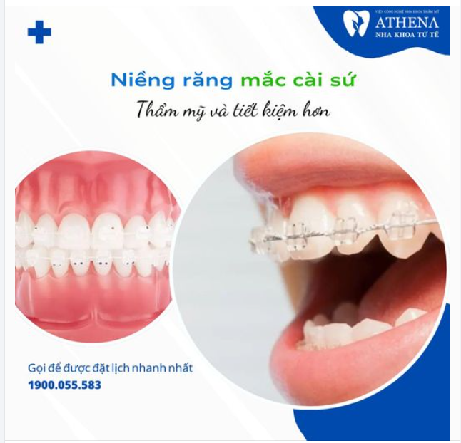 Niềng răng mắc cài sứ : Giải pháp thẩm mỹ đẹp và tiết kiệm