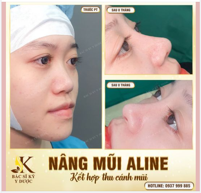 NÂNG CẤP SỰ XINH ĐẸP VỚI DÁNG MŨI ALINE