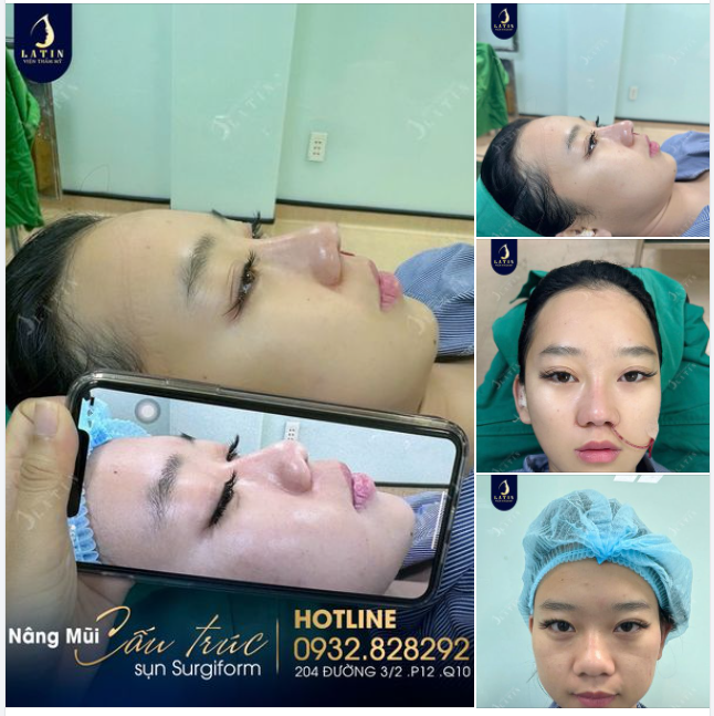Dáng mũi mới vừa hoàn thành cho em gái Trà Vinh