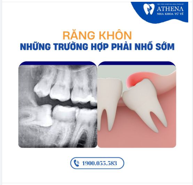 Những trường hợp nhổ răng khôn càng sớm càng tốt