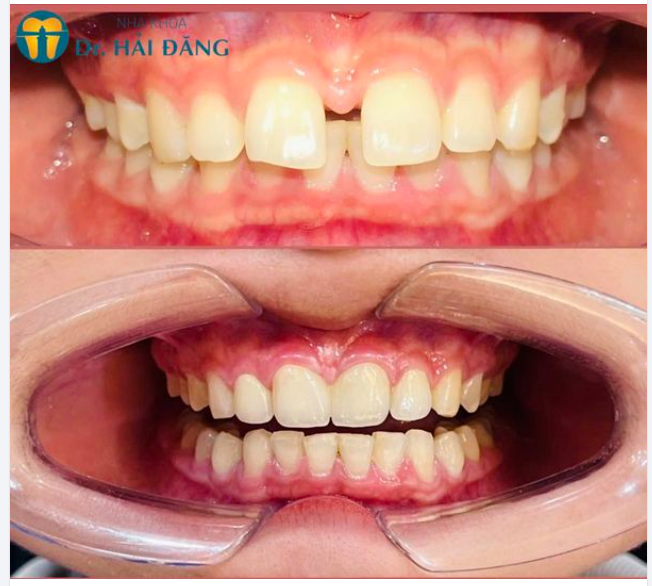 TẠM BIỆT RĂNG THƯA BỌC RĂNG SỨ KHẮC PHỤC KHUYẾT ĐIỂM