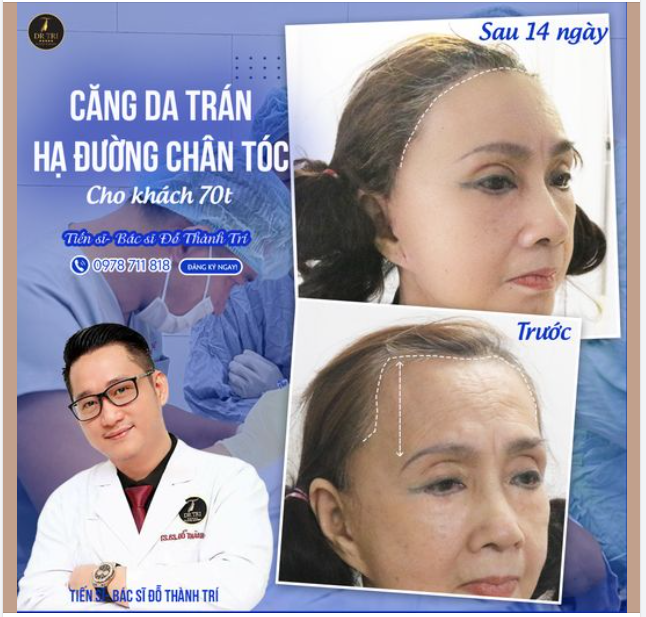 Xóa nếp nhăn vùng trán và tạo hình trán tròn đầy