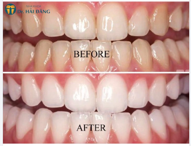 TẨY TRĂNG RĂNG BẬT TONE NGAY CHỈ TRONG 1 GIỜ