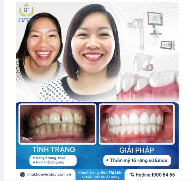 TỰ TIN HƠN VỚI NỤ CƯỜI MỚI