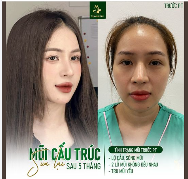 Mũi cấu trúc sửa lại Đẹp Sắc Nét sau 5 tháng!!