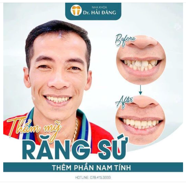 THẨM MỸ RĂNG SỨ THÊM PHẦN NAM TÍNH CHO SOÁI CA