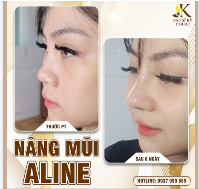 LỰA CHỌN NÂNG MŨI ALINE - LỰA CHỌN SỰ XINH ĐẸP