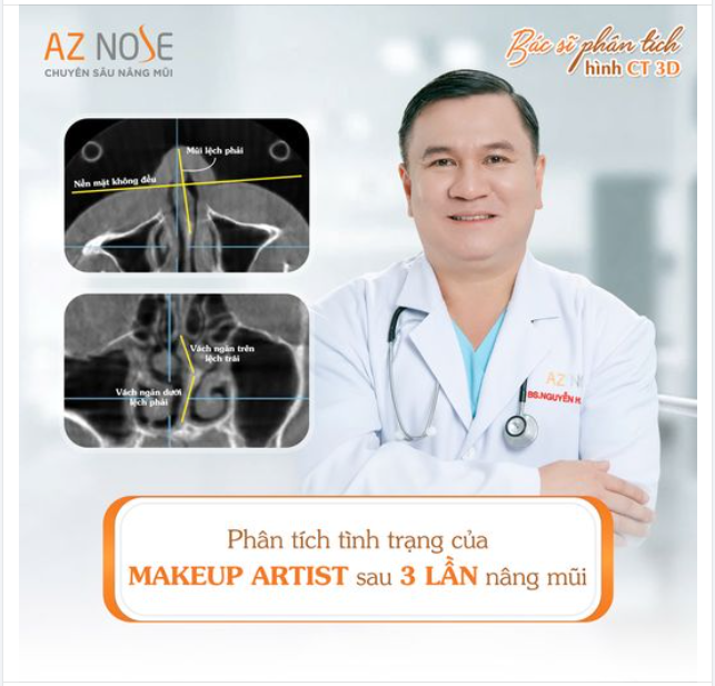 Tình trạng mũi của makeup artist sau 3 lần phẫu thuật