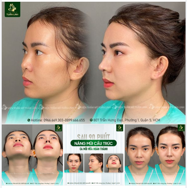 Nâng mũi cấu trúc - Định hình dáng mũi chuẩn đẹp từ mọi góc nhìn!!