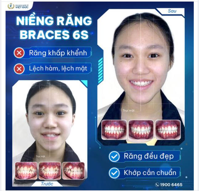 NIỀNG RĂNG HẾT LỆCH MẶT KHÔNG CẦN PHẪU THUẬT