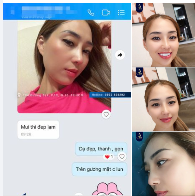 MŨI CẤU TRÚC 10 NGÀY TUỔI NHÉ CẢ NHÀ