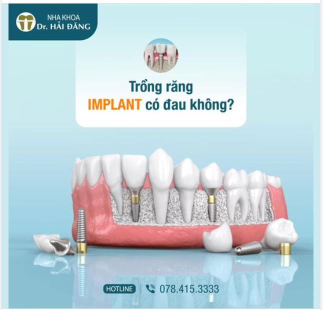 TRỒNG RĂNG IMPLANT CÓ ĐAU KHÔNG ??