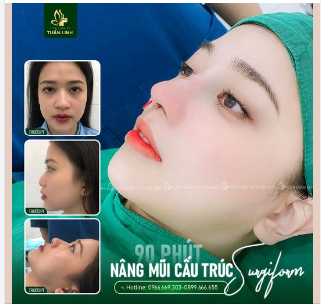 Nâng mũi cấu trúc Surgiform - Mũi đẹp toàn diện - Bền đẹp dài lâu!!