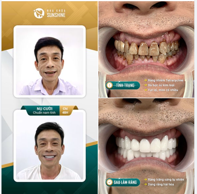 NỤ CƯỜI CHUẨN NAM TÍNH CHỈ SAU 48H