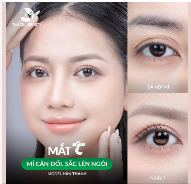 Say bye đôi mắt nhiều nếp mí cho chị em sau 15P thẩm mỹ tại TC