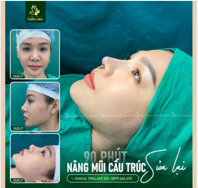 Mũi cấu trúc sửa lại đẹp hài hòa, tự nhiên ngay sau làm!!