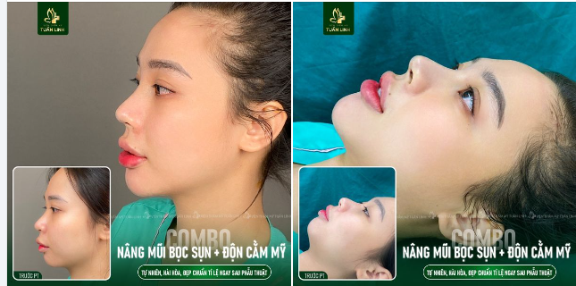 Combo Nâng mũi + Độn cằm Đẹp Tự Nhiên nhưng không tự nhiên mà đẹp!!