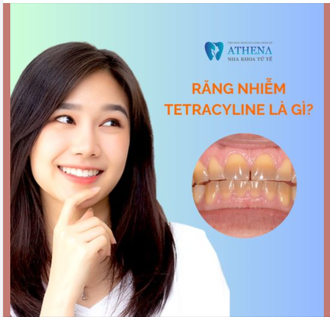 Răng nhiễm tetracycline Là gì?