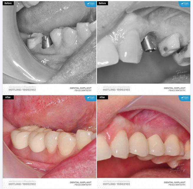 Hình ảnh cho thấy vì sao CẤY GHÉP IMPLANT luôn là lựa chọn tuyệt vời khi mất răng: