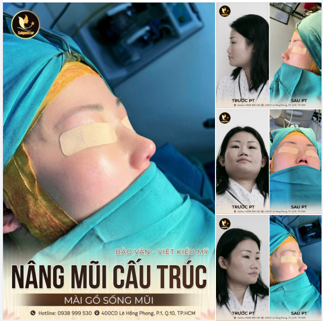 NÂNG MŨI CẤU TRÚC + MÀI GỒ SỐNG MŨI  KH. BẢO VĂN - VIỆT KIỀU MỸ