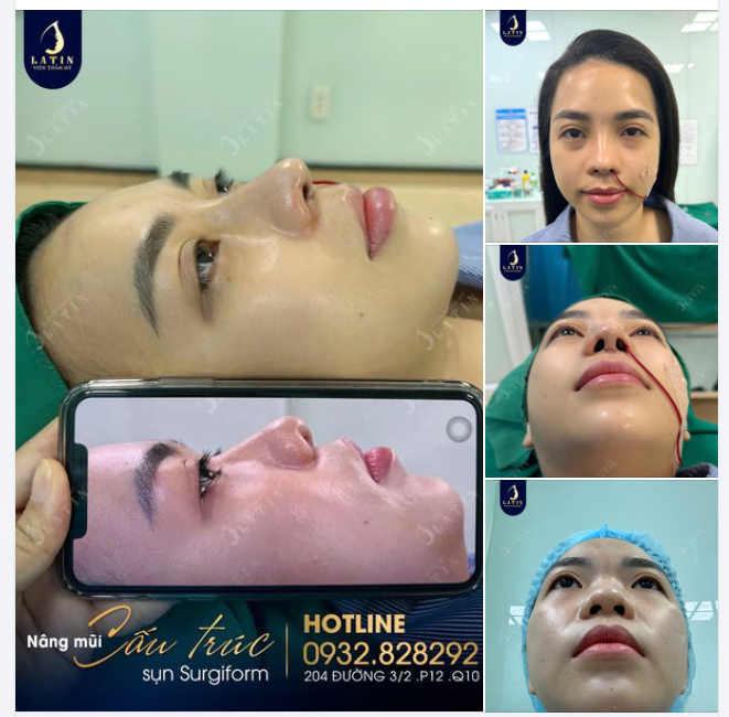 Hành trình từ Sóc Trăng lên Sài Gòn nâng mũi