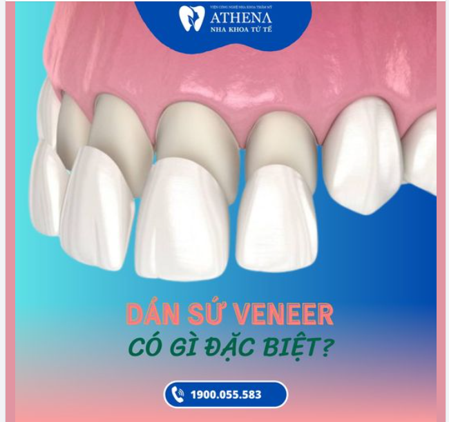 Điểm đặc biệt chỉ có ở Dán sứ veneer