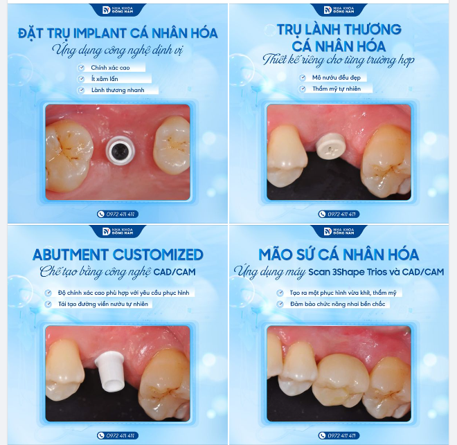 TRỒNG RĂNG IMPLANT “CÁ NHÂN HÓA”: SỰ HOÀN HẢO ĐẾN TỪ CÔNG NGHỆ HIỆN ĐẠI