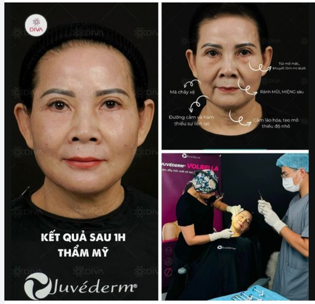 GIẢI PHÁP NÀO GIÚP ĐIỀU TRỊ CHẢY XỆ, LÃO HÓA KHUÔN MẶT MÀ BẠN CÓ THỂ THẤY NGAY KẾT QUẢ?