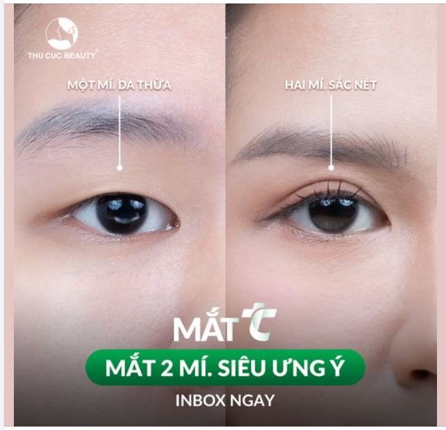 Mắt hai mí, siêu ưng ý