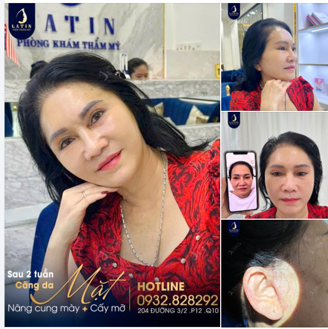 Kết quả Căng da mặt toàn phần + Nâng cung mày sau 2 tuần cho cô khách hàng đến từ Đồng Nai