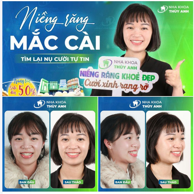 KẾT QUẢ NIỀNG RĂNG ƯNG Ý NHỜ CHỌN ĐÚNG CƠ SỞ, BÁC SĨ UY TÍN