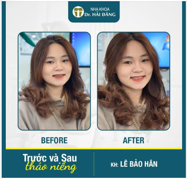 CHÚC MỪNG NGÀY THÁO NIỀNG THÀNH CÔNG